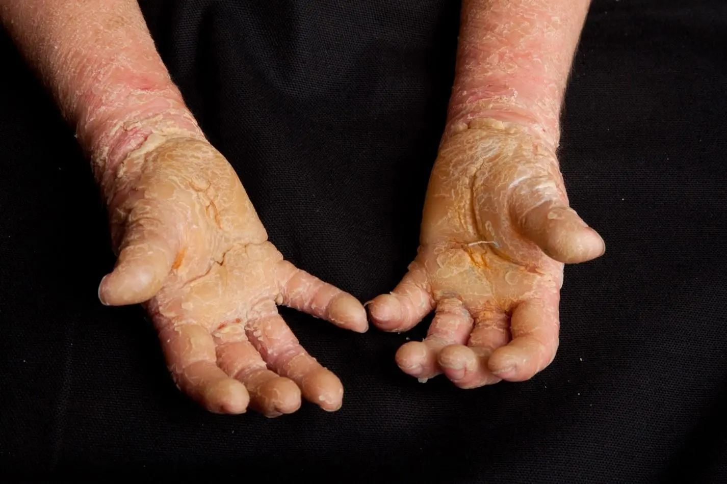 Epidermolytic Ichthyosis hands