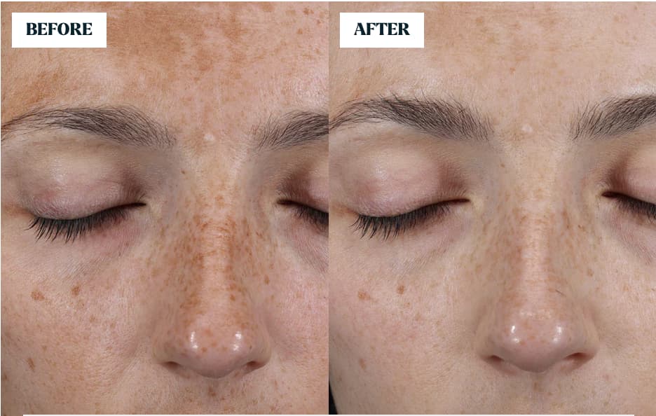 The Hyperpigmentation Serum