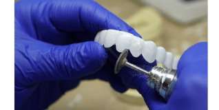WHAT ARE POP ON VENEERS?